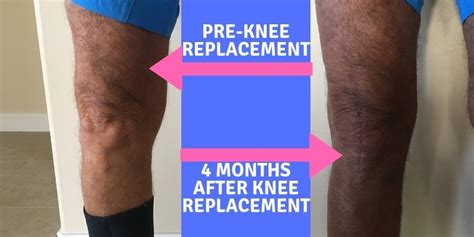 Before And After Knee Replacement Surgery