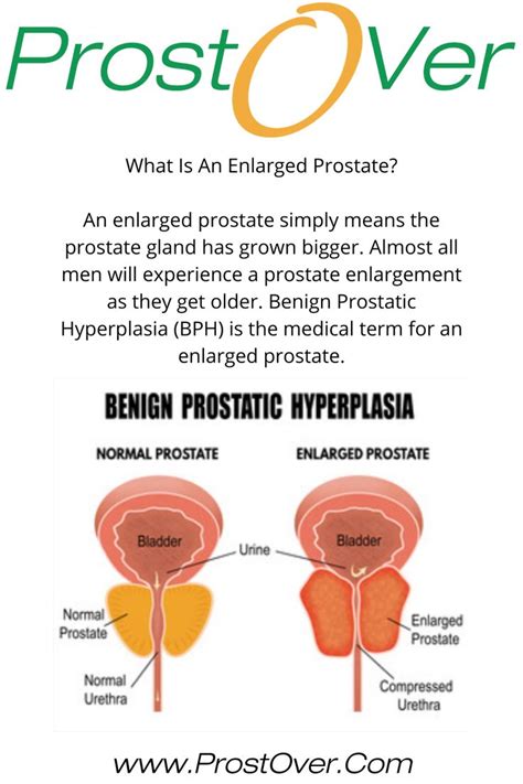 Enlarged Prostate Benign Prostatic Hyperplasia Benign Prostatic
