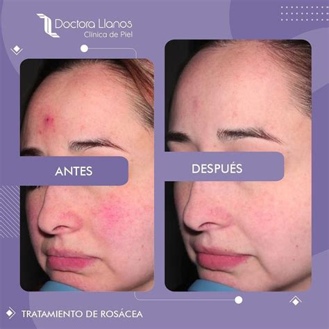 Mester A Templom Melltartó Rosacea Laser Tratamiento Gomba Szigetelje Környéke