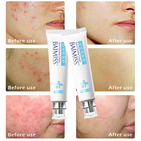 Baimiss Acne Cleaning Cream Skin Care Remove Repair Comedone Pimple