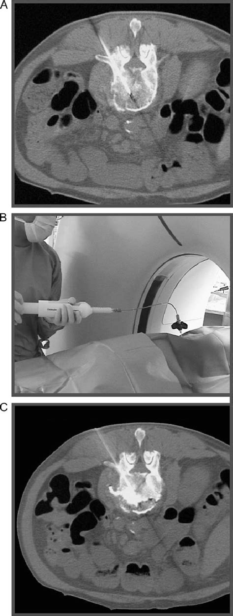 Interventional Procedure Of Percutaneous Vertebroplasty A Insertion
