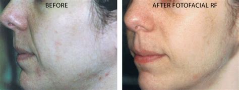 Fotofacial Rf Before And After Gallery Photo 30