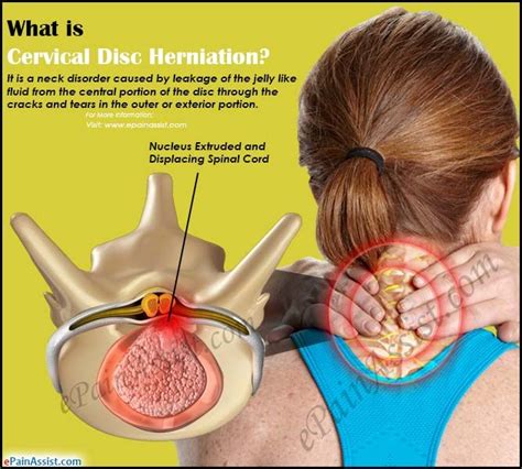 Cervical Disc Herniation Causes Symptoms Diagnosis Treatment How Hot