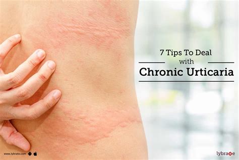7 Tips To Deal With Chronic Urticaria By Dr Deepti Shrivastava Lybrate