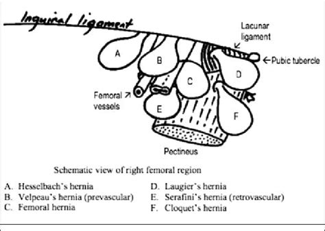 Femoral Hernia Diagram