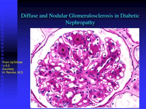 Ppt Diabetic Nephropathy Powerpoint Presentation Free Download Id