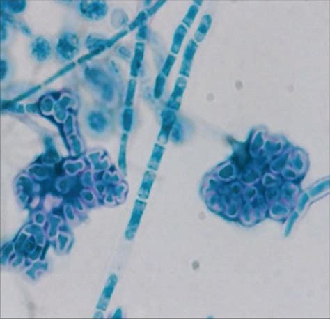 Trichosporon Inkin And Trichosporon Mucoides As Unusual Causes Of White
