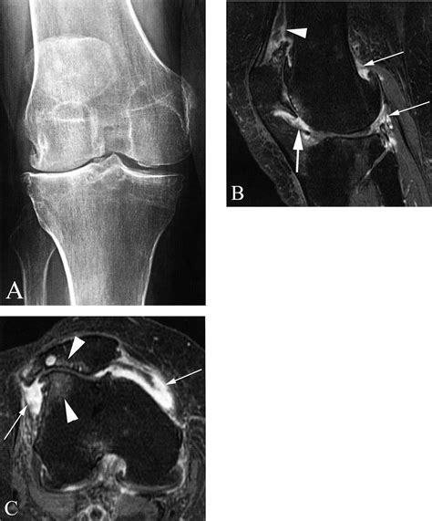 Synovitis In Knee Osteoarthritis Assessed By Contrast Enhanced Magnetic