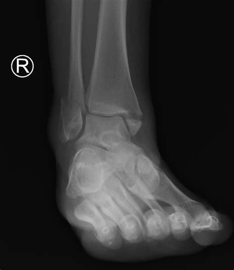 Ankle Fractures Core Em