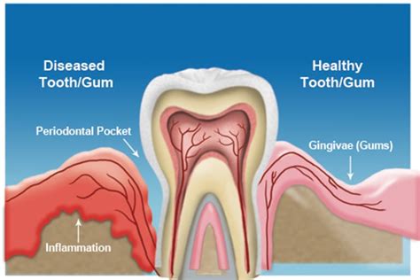 Gum Disease Treatment And Symptoms Dallas Periodontal
