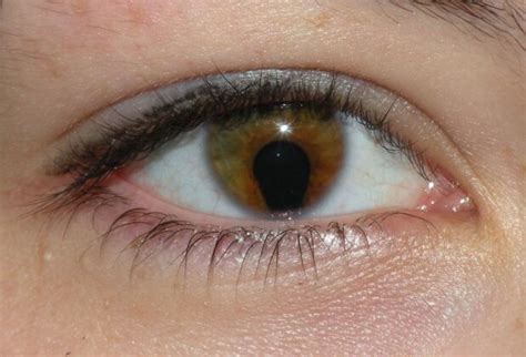 Coloboma A Complete Guide Eyelid Coloboma Surgery