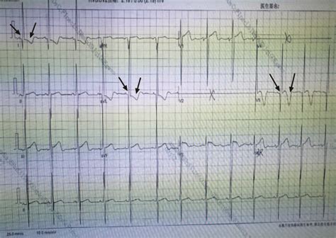 Electrocardiography Showing Abnormal Q Waves In Leads I Avl And V5