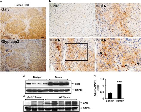 Galectin 3 Is Upregulated In Hepatocellular Carcinoma Hcc Tumor Cells