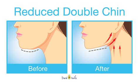 The Best Exercises For Getting Rid Of That Unwanted Double Chin And Neck