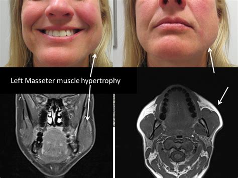Masseter Hypertrophy Facial Swelling Botulinum Toxin Treatment Iowa