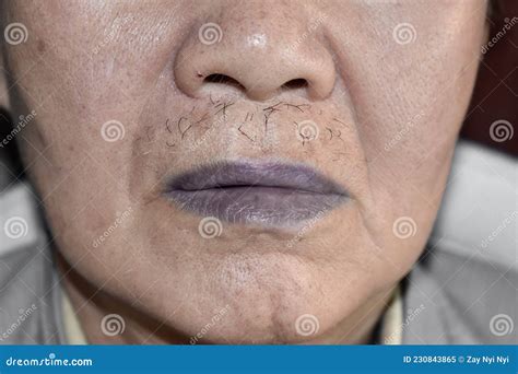 Cyanotic Lips Or Central Cyanosis At Southeast Asian Old Man Stock