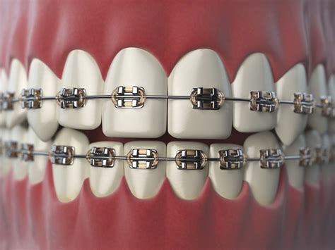 Orthodontic Retainers Their Importance After Braces Bresdel