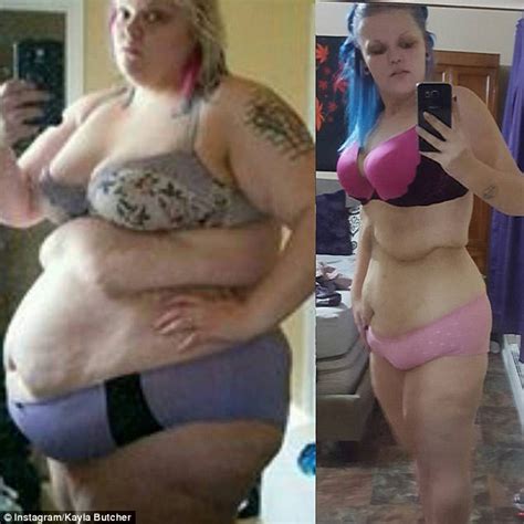 Woman Who Lost 186lbs Left With Apron Of Excess Skin Daily Mail Online