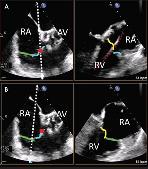 Imaging Considerations For Percutaneous Tricuspid Intervention