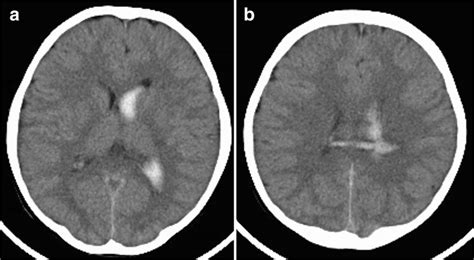 Initial Computed Tomographic Images Showing Intraventricular Hemorrhage