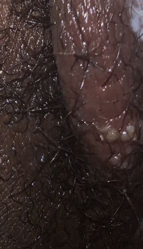 What Do You Guys Think This Is Herpes Or Follicullitus