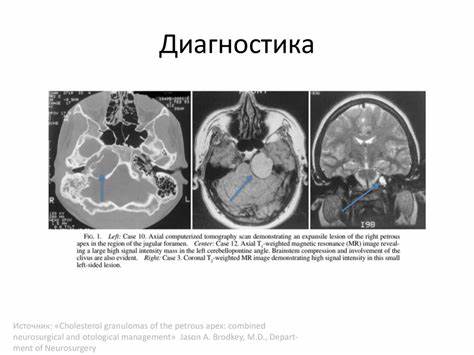 Диета холестериновая 10 Холестериновая гранулема - презентация онлайн Холестериновая гранулема - презентация онлайн Диета холестериновая 10