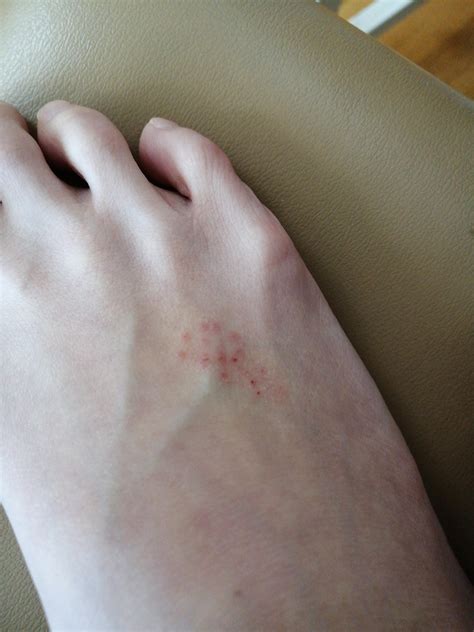 Some Red Dots On My Foot What Is It Medicaladvice