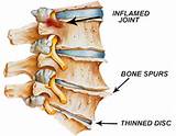 Therapy For Degenerative Disc Disease Images