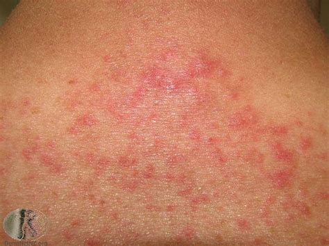 How To Identify 4 Common Skin Rashes Alergia Piel Pic Vrogue Co