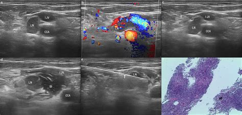Frontiers Comparison Of Ultrasound Guided Core Needle Biopsy Under