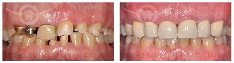 Restoration involved orthodontics, orthognathic, imlant placement, etc. dentist pattaya, dental pattaya, implant pattaya, ทำฟัน ...