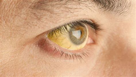 Yellow Eyes Causes In Newborns Children And Adults