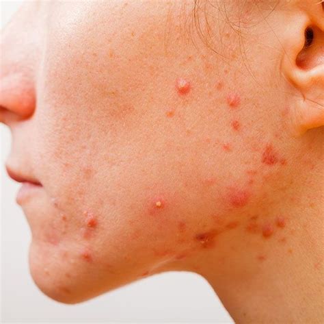 Dr Rachel Ho Acne Types Causes Treatments And Tips For Prevention