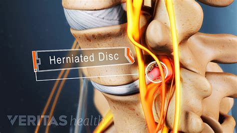 To figure out if you have a herniated disc, you. Sciatica Exercises and Sciatica Pain Relief for a ...