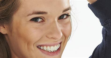Eine Feste Zahnspange Mit Innovativen Brackets Hat Viele Vorteile
