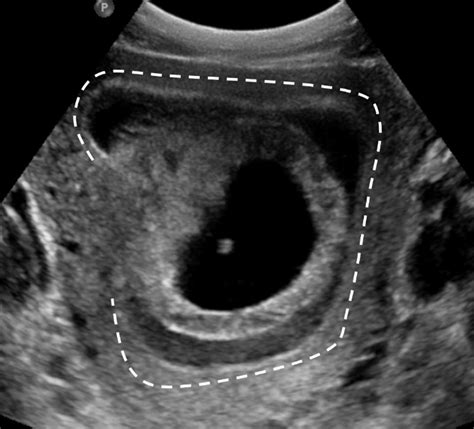 Ultrasound Of The First Trimester Radiologic Clinics