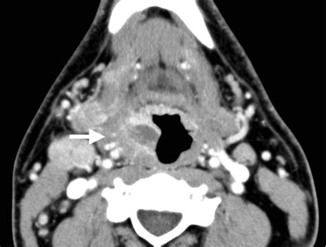 Squamous Cell Carcinoma Of The Nasopharynx Axial Ct Scan With Contrast