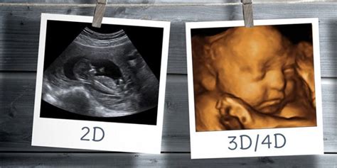 Obstetrics 3d 4d Ultrasound