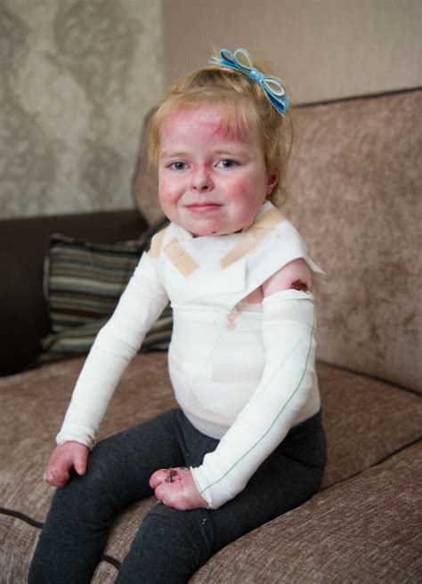 Five Year Old Launches Campaign For People With Butterfly Skin Disease
