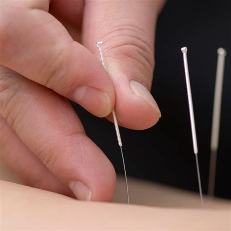 Acupuncture For Carpal Tunnel And Wrist Problems