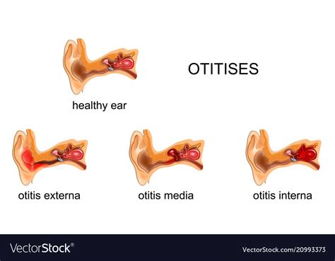 Ear Otitis Media Internal External Royalty Free Vector Image