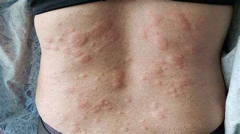 Hives Symptoms How You Know Its Really Hives Everyday