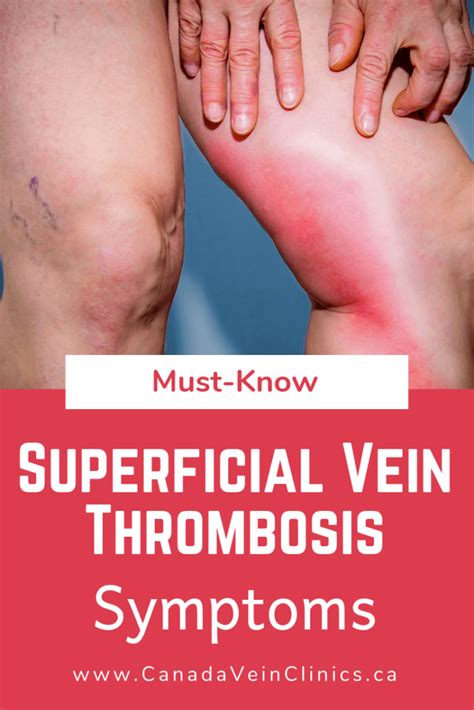 Superficial Vein Thrombosis Complications Of Varicose Veins Canada