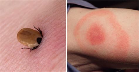 Lyme Disease How To Protect Yourself And Prevent This Deadly Disease