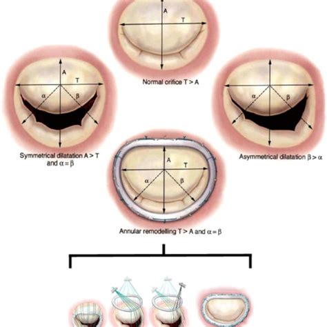 A And B Tiara Tm Catheter Based Mitral Valve Replacement System