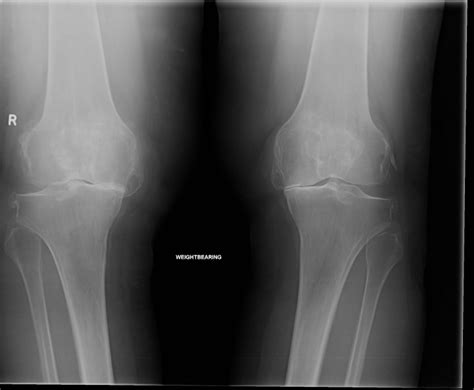 Knee Arthritis Sunshine Coast Knee And Hip Clinic
