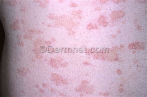 Pityriasis Rosea Photo Skin Disease Pictures