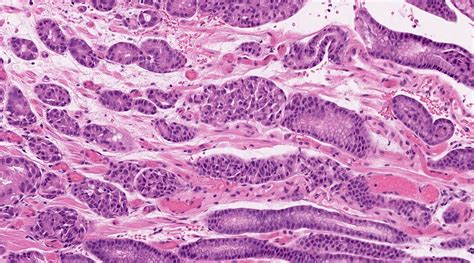 Pathology Outlines Hereditary Diffuse Gastric Cancer