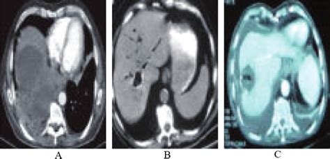 A Ct Image Of Rupture Of Hydatid Cyst In The Lung B Ct Scan Of