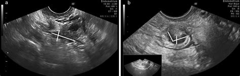 bowel preparation prior to transvaginal ultrasound improves detection of rectosigmoid deep